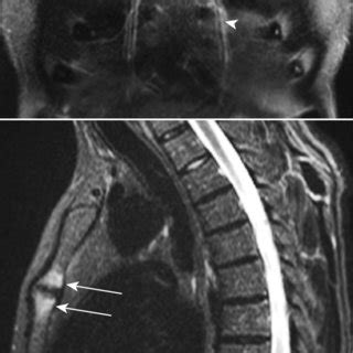 acw meaning medical|Anterior chest wall inflammation by whole.